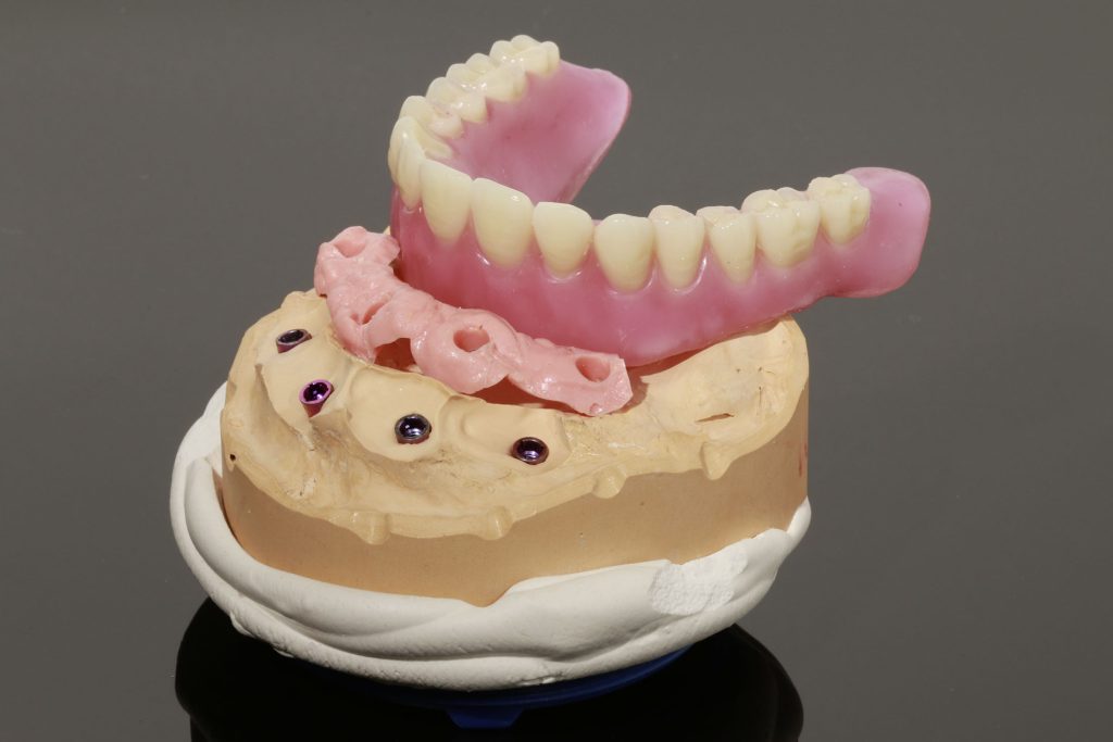 3_Implantatsteg_Zahnfleischmaske_Aufstellung