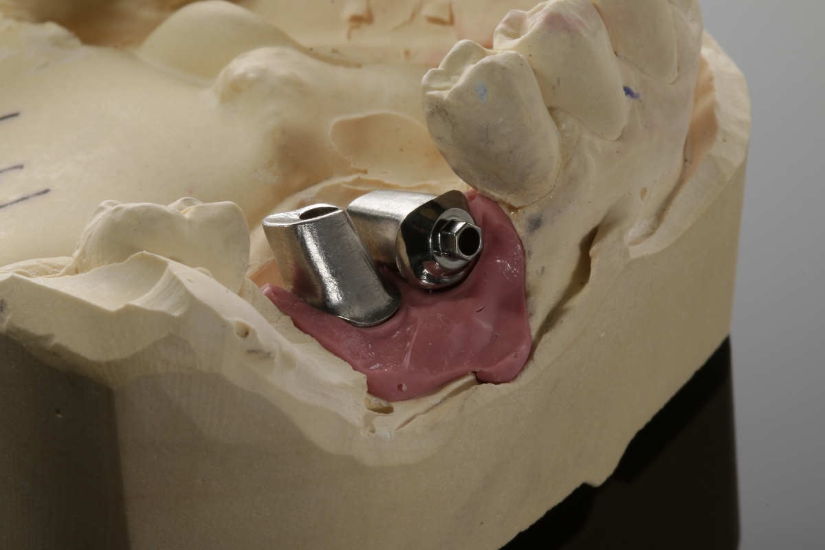 individuelle_Abutments_kompatibel_zu_Zimmer_Tapered_Vent_3635