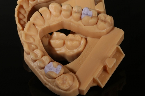 6_EMAX_Inlays__Inlays_9824