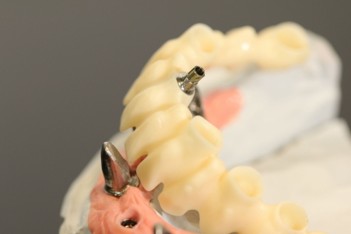 Straumann_Bonelevel_Preform_Abutment_0642