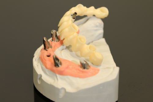 Zirkon_Gerüst_Pritidenta_IMG_0650