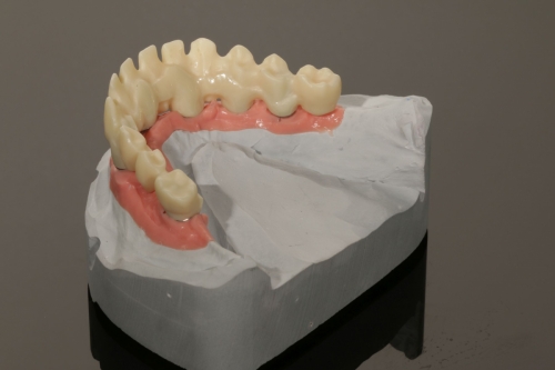 Zirkon_Gerüst_Pritidenta_IMG_0657