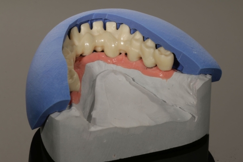 Zirkon_Gerüst_Pritidenta_IMG_0659